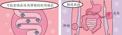 【肛肠健康】放屁太多是肠癌的警示,是真的吗?